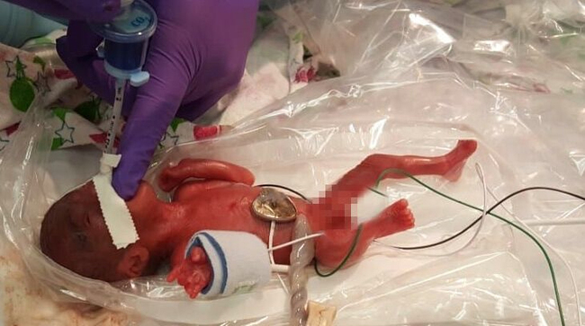 In this picture received by AFP from Sharp Mary Birch Hospital for Women & Newborns on May 29, 2019, shows baby Saybie, the world's smallest surviving newborn, when she was born in December 2018 in San Diego, California. [Photo: AFP]