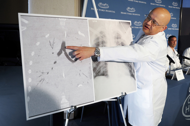 In this Nov. 12, 2019 file photo, Dr. Hassan Nemeh, surgical director of Thoracic Organ Transplant, shows areas of a patient's lungs during a news conference at Henry Ford Hospital in Detroit. [Photo: AP]