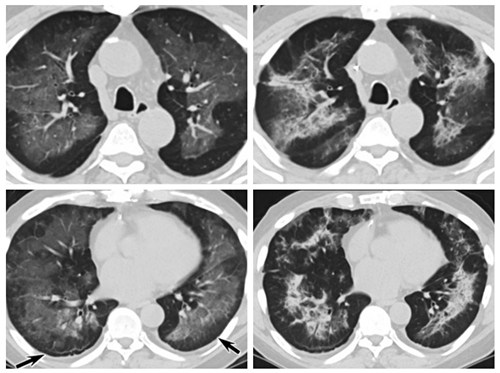 CT snímky pacientů s EVALI v USA z roku 2019 označené za „mírně podezřelé“, že šlo o COVID-19.