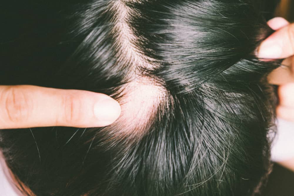 alopecia (foto nga injuries.co.za)